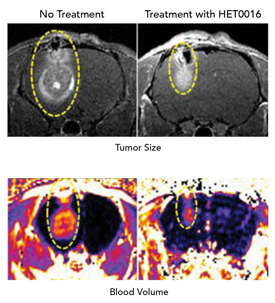 Animal MRIs of a glioblastoma before and after treatment with an 20-HETE inhibitor. Both the tumor volume and blood flow were significantly reduced.