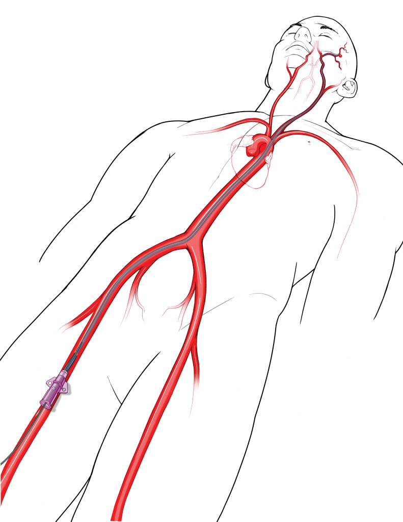 drawing of an angioman process