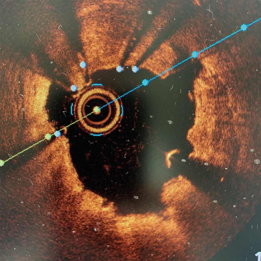 picture after a stent is placed.