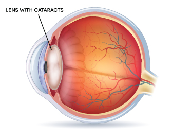 drawing of eye with a cataract