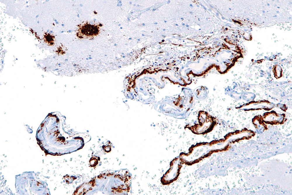 Micrograph of cerebral amyloid angiopathy with senile plaques (brown) in the cerebral cortex consistent with amyloid beta, as seen in Alzheimer's disease.