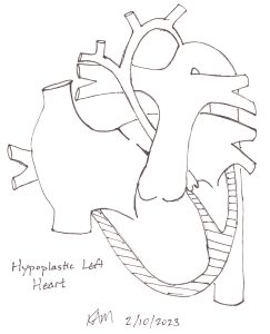 drawing of hypoplastic left heart